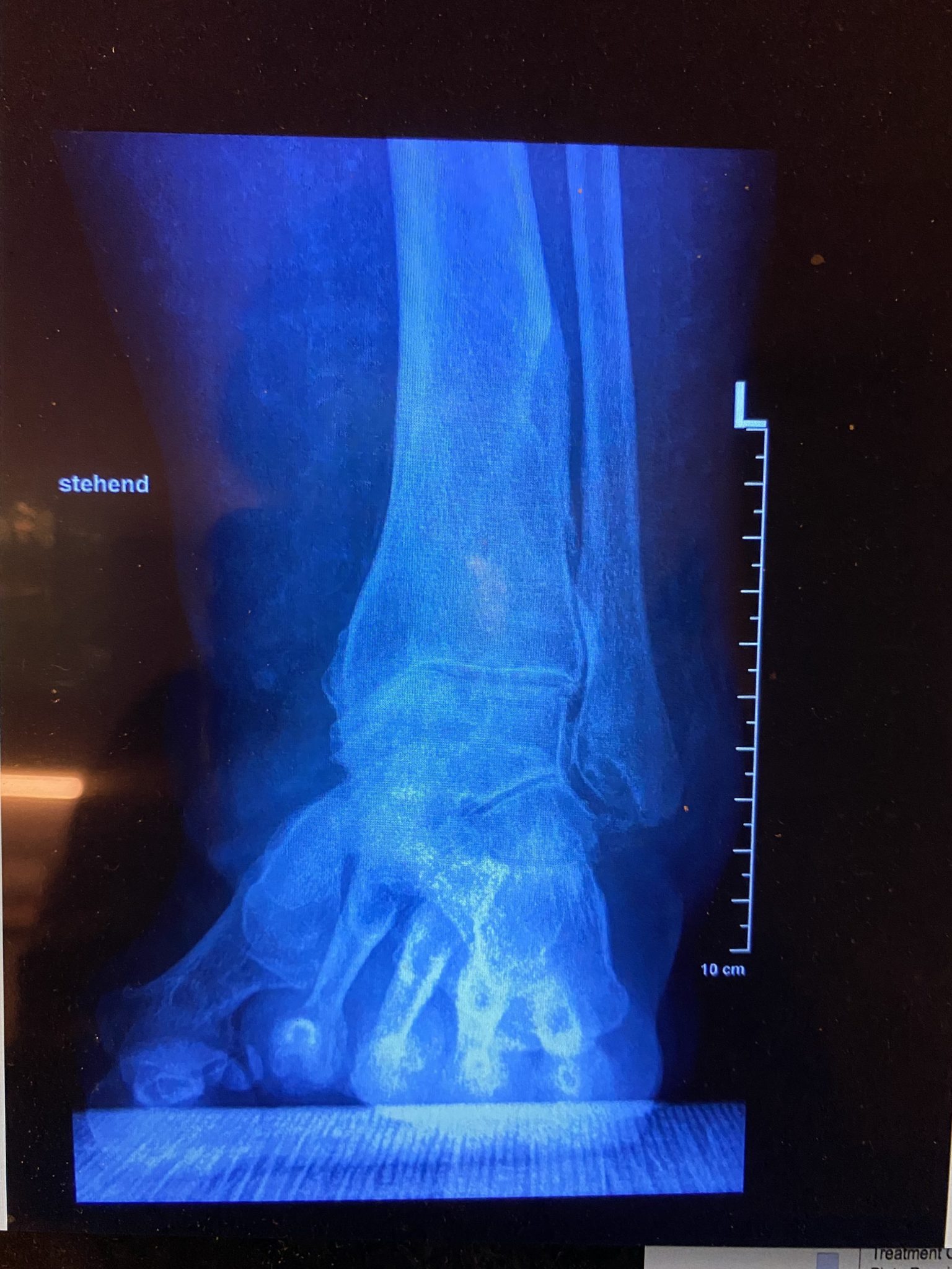 Arthrose Sprunggelenk Priv.Doz. Dr. Peter Bock